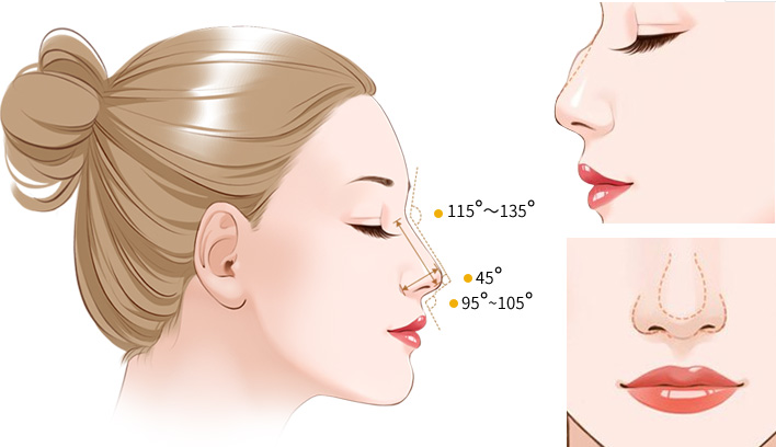 自體耳軟骨隆鼻的優(yōu)缺點？