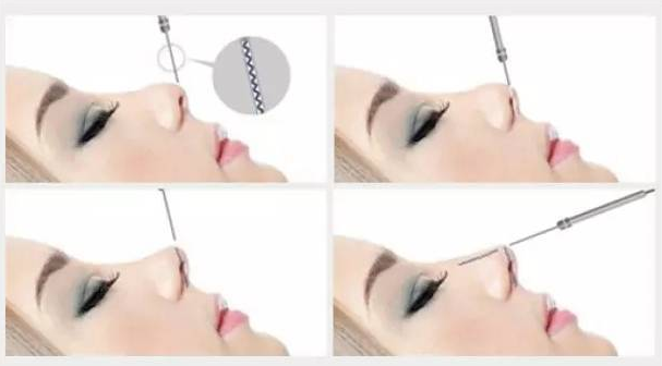 西安美萊整形醫(yī)院假體隆鼻手術(shù)前后案例分享，實(shí)力醫(yī)院推薦