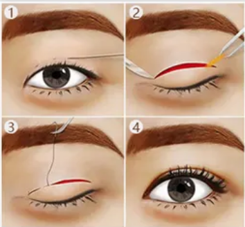 南京華美整形醫(yī)院全切雙眼皮案例分享，實(shí)力醫(yī)院推薦