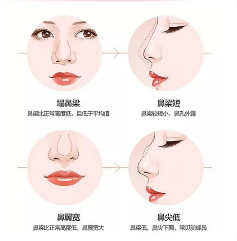 金爾麗整形醫(yī)院假體隆鼻，項目價格表及簡介一覽