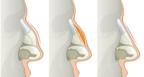 長沙隆鼻醫(yī)生推薦：秦曉東、易東風(fēng)、丁翔小翹鼻大咖