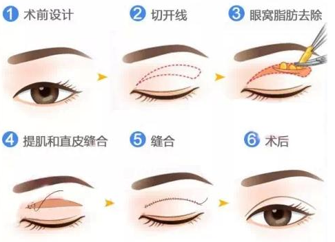 解放軍沈陽(yáng)軍區(qū)總醫(yī)院整形科雙眼皮手術(shù)詳細(xì)介紹、附帶真人案例和價(jià)格表