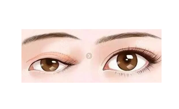 徐州二院哪個(gè)醫(yī)生做雙眼皮好？陶常波、張愛君等實(shí)力過硬