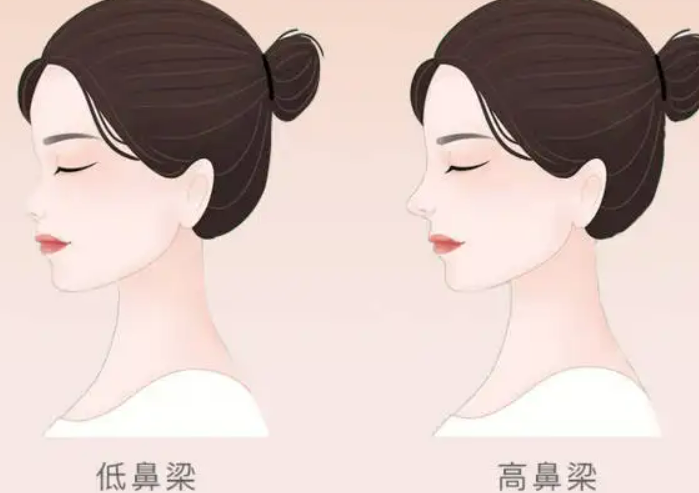 北京協(xié)和醫(yī)院整形科隆鼻案例分享展示，附上圖