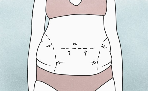 深圳曹孟君吸脂果怎么樣？案例恢復(fù)果反饋