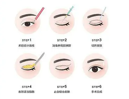 割雙眼皮類型有哪些？具體要怎么操作？