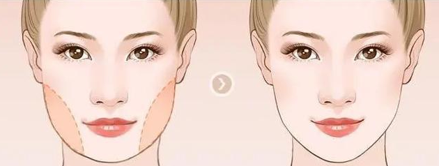 成都瘦臉整形手術(shù)那家醫(yī)院好？瘦臉前后案例信息分享