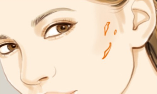 廣州可玉整形醫(yī)院激光祛疤手術(shù)案例分享，實(shí)力醫(yī)院推薦