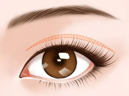 重慶大坪醫(yī)院整形科雙眼皮手術(shù)案例分享，內(nèi)附相關(guān)整形問答