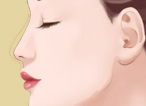 廣州荔醫(yī)醫(yī)療美容整形醫(yī)院隆鼻怎樣？附案例分享