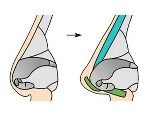 重慶美萊醫(yī)療美容醫(yī)院隆鼻整形案例分享_附相關(guān)問答