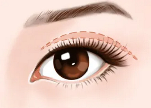 成都畫美整形醫(yī)院全切雙眼皮案例分享，實力醫(yī)院推薦