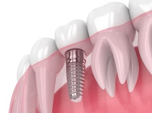 威海市立醫(yī)院種植牙費用多少？口腔科實力概況及種牙效果