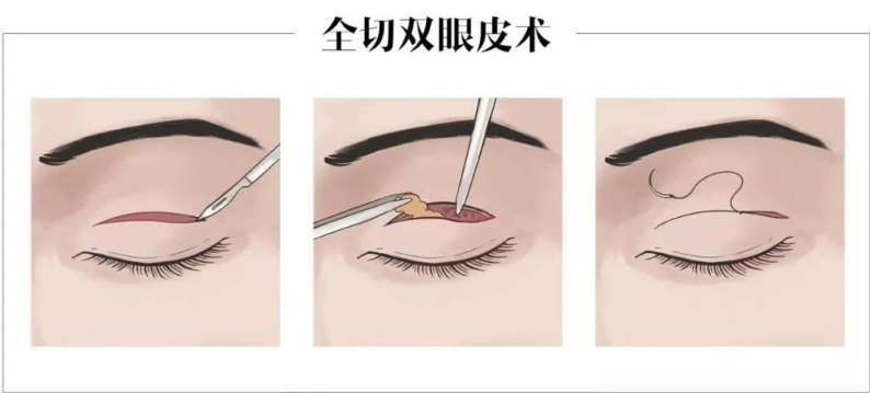 北京八大處割雙眼皮怎么樣？實力醫(yī)院技術信息在線瀏覽