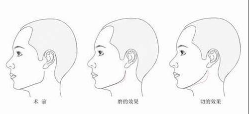 長沙晶膚醫(yī)療美容醫(yī)院顴骨整形手術(shù)技術(shù)好不好？費(fèi)用價(jià)格多少？真人反饋怎么樣？