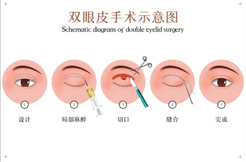 上海九院整形外科做雙眼皮修復(fù)多少錢？熱門醫(yī)生介紹+雙眼皮修復(fù)案例