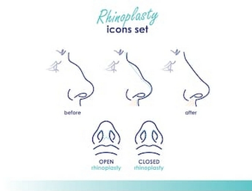 昆明市第一人民醫(yī)院整形科鼻子做的好嗎？效果自然，get美鼻