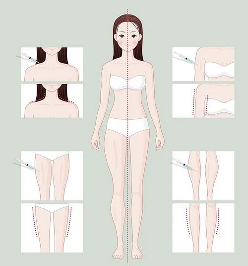 深圳美萊醫(yī)療整形美容醫(yī)院吸脂怎么樣？實(shí)力醫(yī)生推薦+術(shù)后效果反饋~