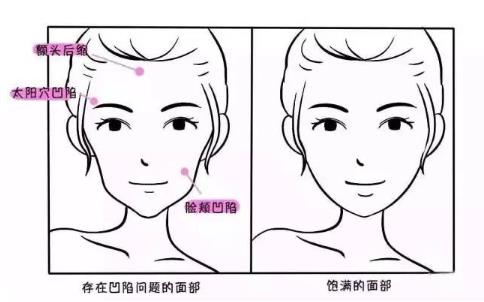 龍泉中醫(yī)院整形科玻尿酸注射抗衰真人案例分享