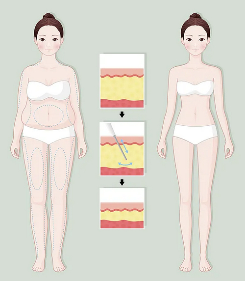 北京協(xié)和醫(yī)院整形美容科怎么樣？腰腹吸脂真人案例