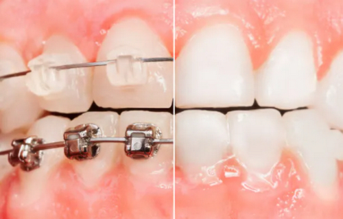 正畸\牙齒種植前一定要了解的小知識(shí)！