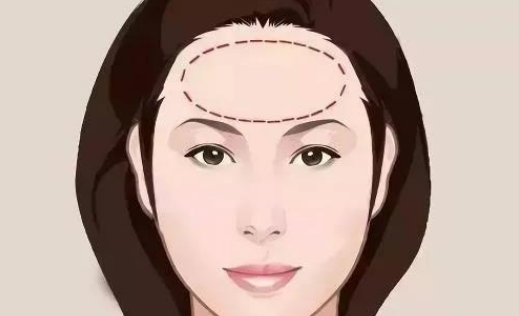 喬雅登雅致適合做哪些部位？皺紋拜拜|玻尿酸去抬頭紋案例附上