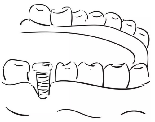 無錫新瑞醫(yī)院牙科種植牙怎么樣？奧齒泰牙齒種植效果分享