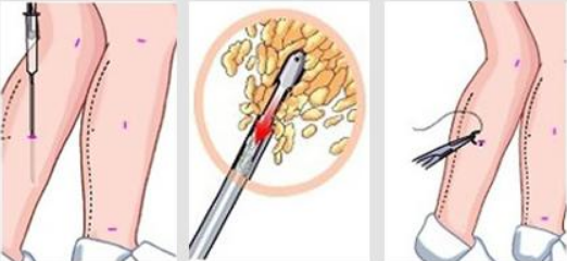 徐州市中心醫(yī)院整形美容科吸脂怎么樣？技術(shù)、口碑分享、機(jī)構(gòu)介紹