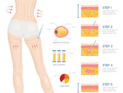 昆山市第一人民醫(yī)院整形科吸脂多少錢(qián)？案例效果及醫(yī)院信息附上