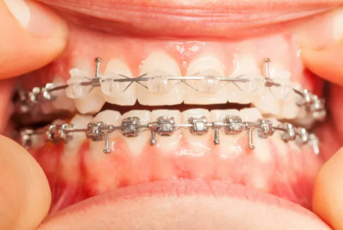 金屬托槽矯正和自鎖托槽矯正區(qū)別是什么？