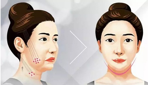 紹興熱瑪吉的價(jià)格貴嗎?排名前3醫(yī)生全新名單發(fā)布