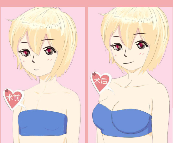 成都三醫(yī)院隆胸多少錢(qián)？專業(yè)醫(yī)生集結(jié)、案例術(shù)后效果圖