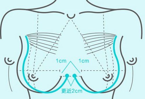 泉州二院美容整形科隆胸多少錢(qián)？效果好不好？附案例展示