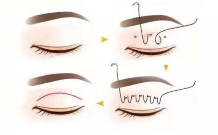 南醫(yī)大二附院雙眼皮多少錢？成功上岸！保姆級(jí)恢復(fù)經(jīng)驗(yàn)分享