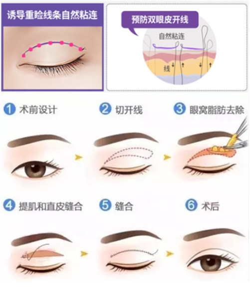 江南大學(xué)附屬醫(yī)院雙眼皮修復(fù)貴嗎？指南分享|沉浸式體驗(yàn)做雙眼皮