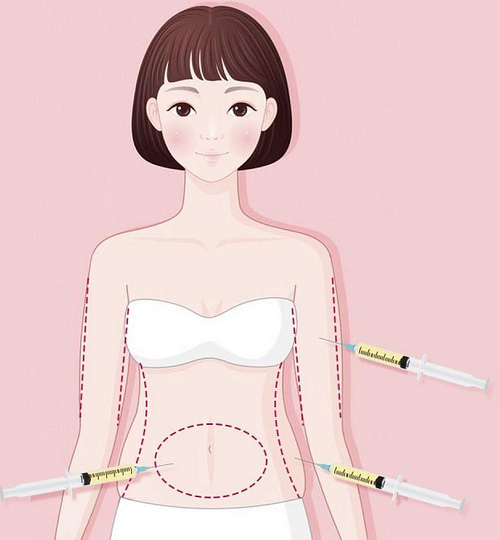 湛江奧泰美整形醫(yī)院腹部吸脂要多少錢？術(shù)后反饋及科普問答