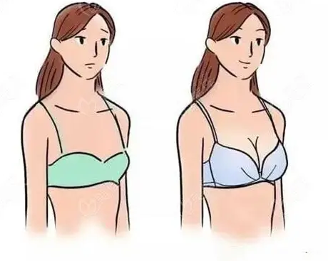 胸部輪廓不，隆胸技術(shù)了解一下！