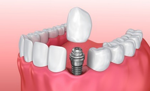 十堰仁美口腔醫(yī)院牙齒種植案例分享，內(nèi)附醫(yī)院信息