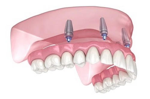 湘潭中心醫(yī)院種植牙需要多少錢，醫(yī)院信息資料+案例