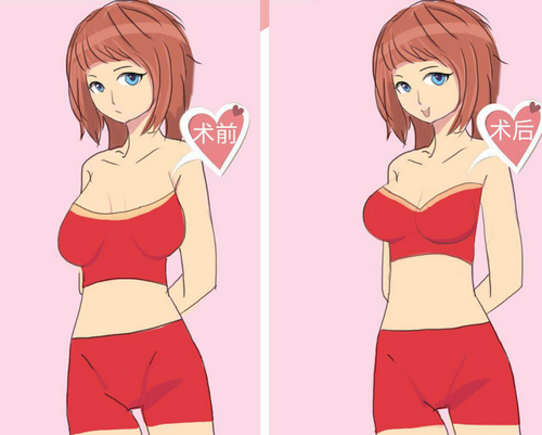 胸部提升手術有風險嗎？