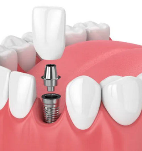 中山香山口腔醫(yī)院種植牙多少錢一顆？內(nèi)附種牙費(fèi)用、醫(yī)生信息