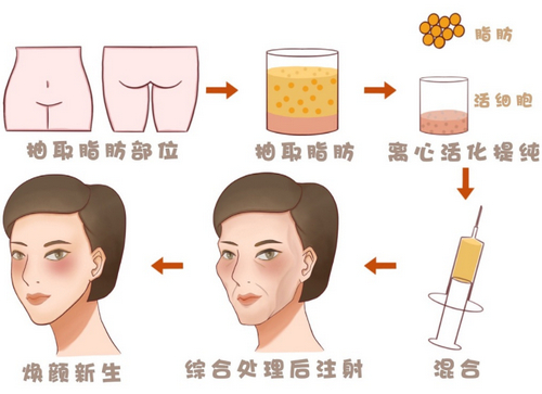 成都艾米麗脂肪填充怎么樣？醫(yī)院介紹/術(shù)后恢復(fù)過程大揭秘