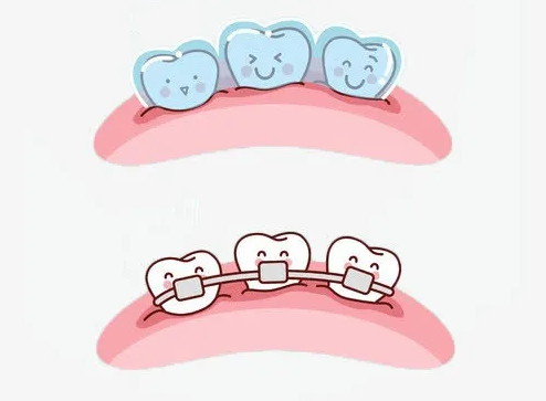 隱適美矯正大概多少錢？