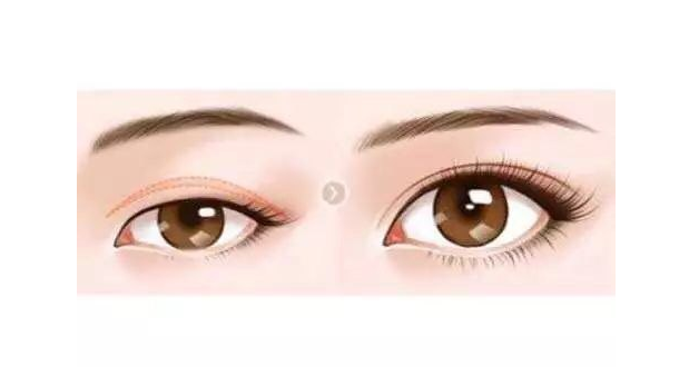 廣州醫(yī)科大學附屬第一醫(yī)院整形外科雙眼皮手術(shù)貴不貴？實際案例分享