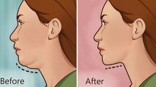 新鄉(xiāng)371醫(yī)院美容整形科吸脂價(jià)格|恢復(fù)過(guò)程日記分享