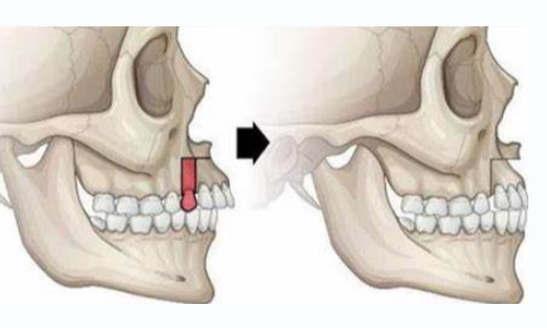 青島市城陽區(qū)人民醫(yī)院整形美容科顴骨怎么樣？真人感受反饋、價(jià)格說明