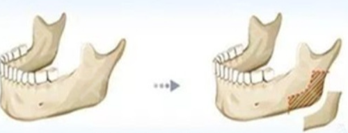 劉彥普正頜手術(shù)做得怎樣？坐診空軍軍醫(yī)大學(xué)口腔醫(yī)院口腔頜面外科