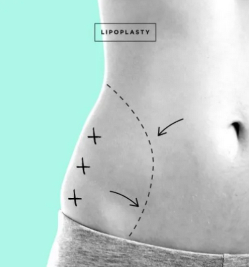 南京抽脂手術大概花多少錢?優(yōu)秀醫(yī)院詳細資料附上
