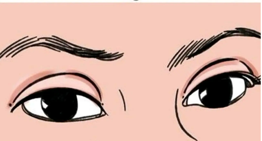 做整形雙眼皮手術(shù)必看：關(guān)于恢復(fù)期必須要熬過的5大階段，你一定要知道！