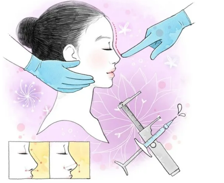 隆鼻手術(shù)能維持多久？術(shù)后如何快速消腫？我們一起來看看